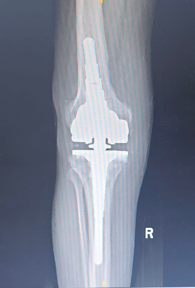 After hip fracture fixation X-ray with plate and screws